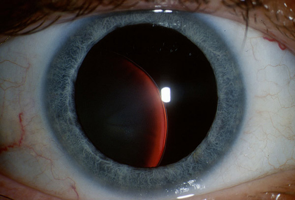 Сублюксация хрусталика