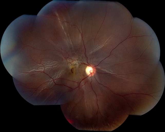 Травматическая отслойка сетчатки с макулярным разрывом