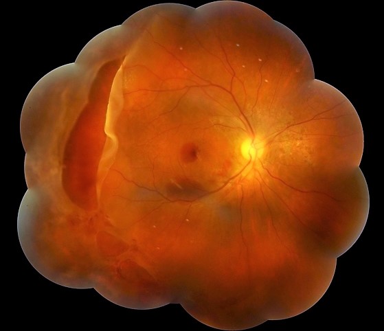 Множественные повреждения сетчатки вследствие тупой травмы глаза