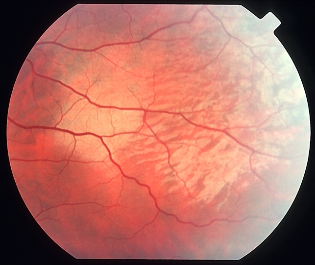 Берлиновское помутнение сетчатки