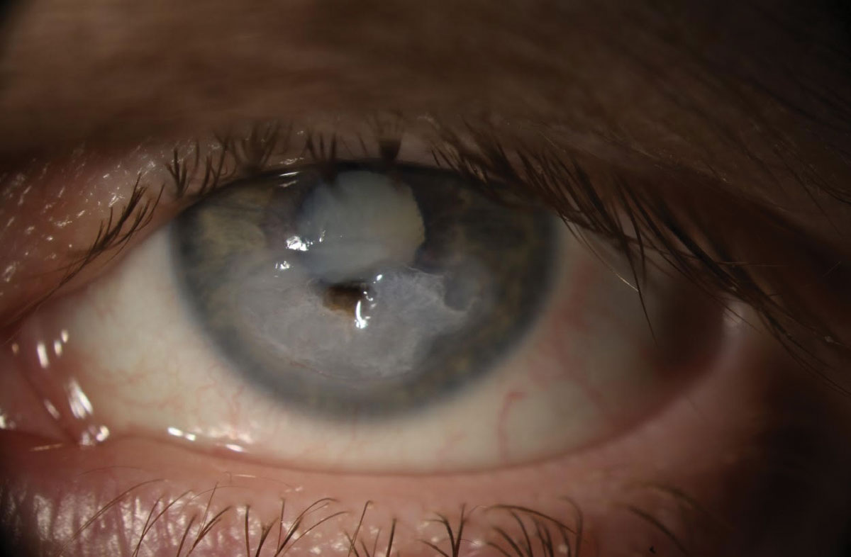 Нейротрофический кератит