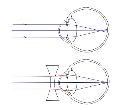 Коррекция миопии двояковогнутой линзой