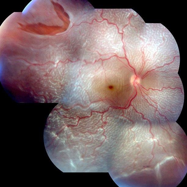 Регматогенная отслойка сетчатки