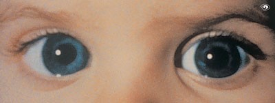 Увеличение глазных яблок при врожденной глаукоме