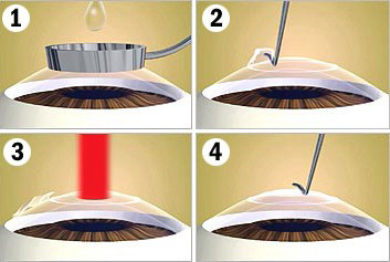 Техника LASEK