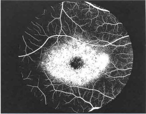ФАГ при колбочковой дистрофии: картина "бычьего глаза" с "окончатым" дефектом.