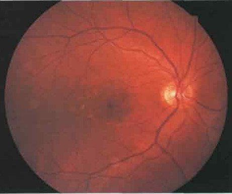 Макулярная дистрофия Штаргардта с парамакулярными пятнами