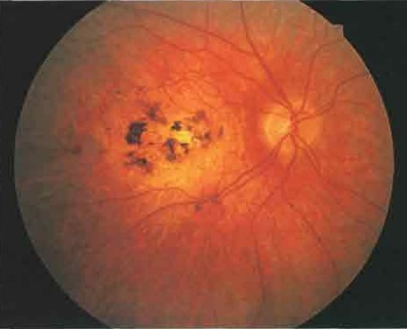 Макулярная дистрофия Штаргардта в развитой стадии