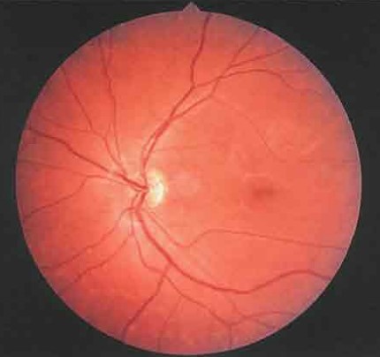 Ранняя стадия макулярной дистрофии Штаргардт