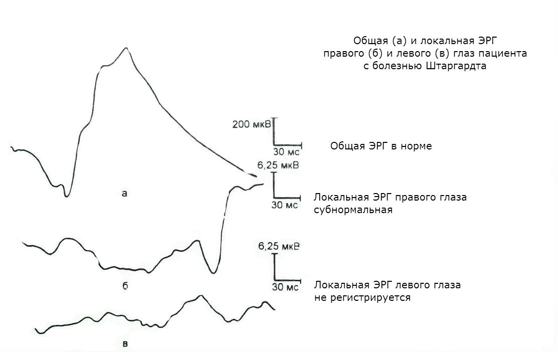 ЭРГ при болезни Штаргардта