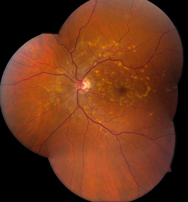 Болезнь Штаргардта