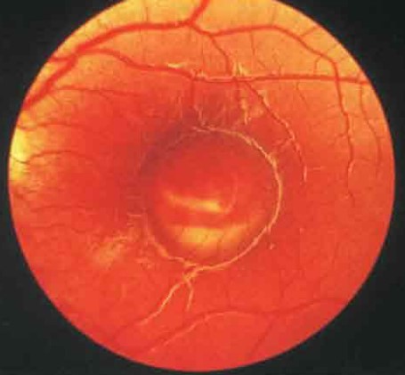 Стадия псевдогипопиона