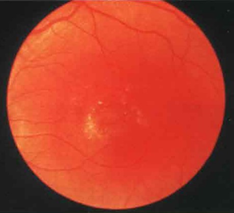 Стадия разрыва кисты в виде яичного желтка