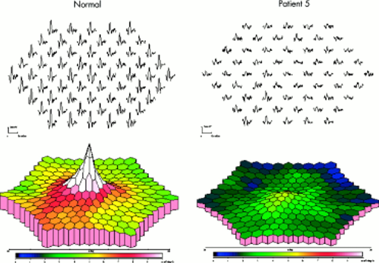 Болезнь Беста