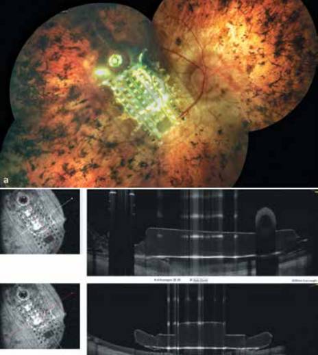 Цветное фундус-изображение у пациента с имплантом Argus II