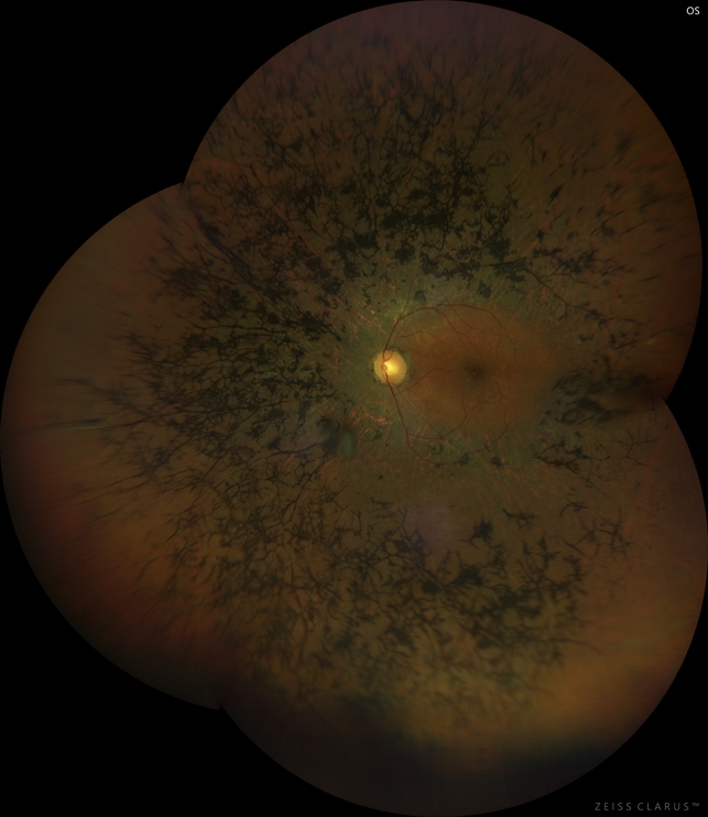 Пигментный ретинит