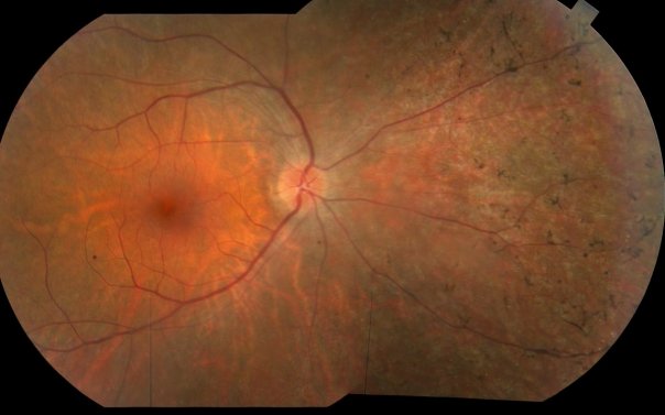 Сетчатка человека с пигментным ретинитом