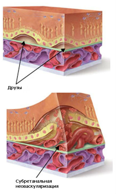 Друзы Vs Субретинальная неоваскуляризация