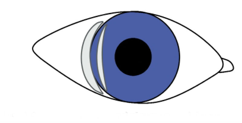 Схема оценки ширины угла передней камеры по методу Ван Херика