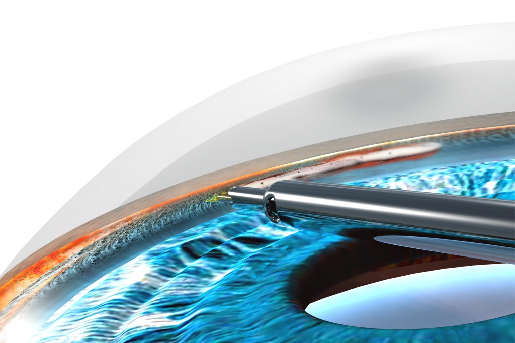 Микроинвазивная хирургия глаукомы