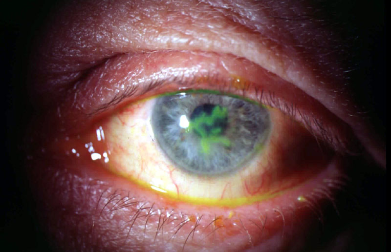 Герпетический кератит