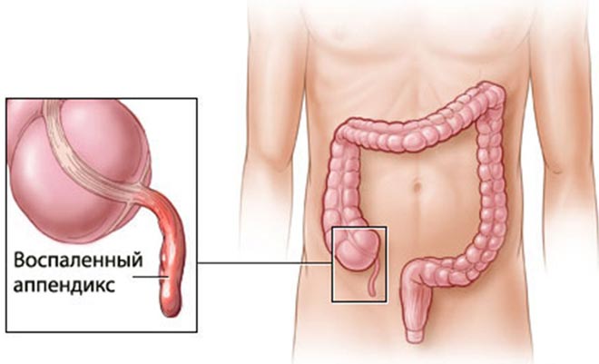 аппендицит у взрослых