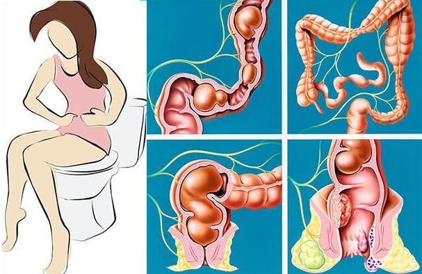 При поносе вылез геморрой при поносе вылез геморрой