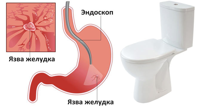 понос при язве