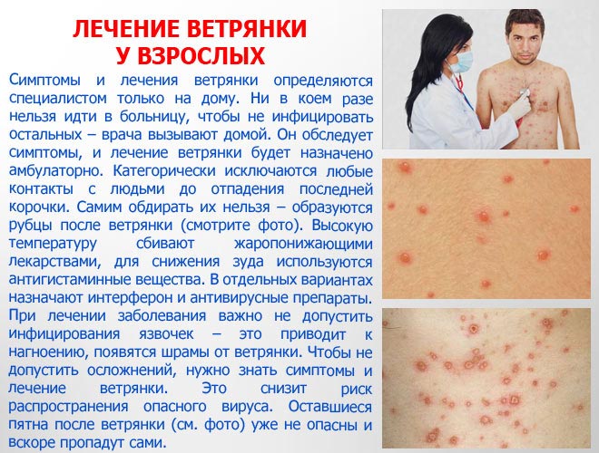 Лечение ветряной оспы у взрослого Лечение ветряной оспы у взрослого