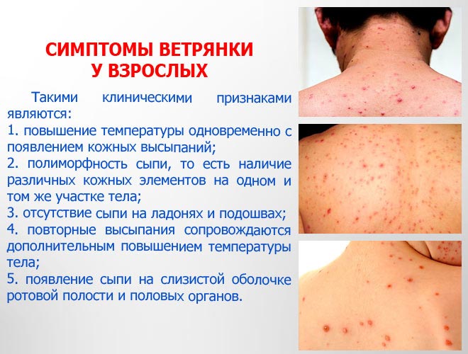 Симптомы у взрослых Симптомы у взрослых