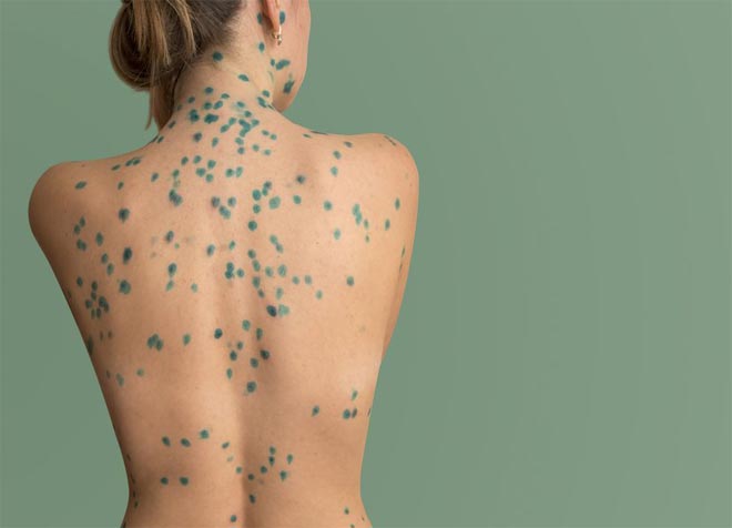 Ветряная оспа Ветряная оспа