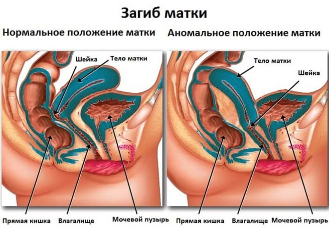 Загиб матки Загиб матки