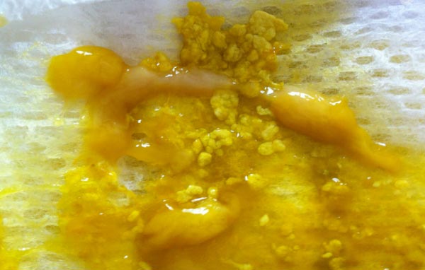 Желтый понос со слизью Желтый понос со слизью