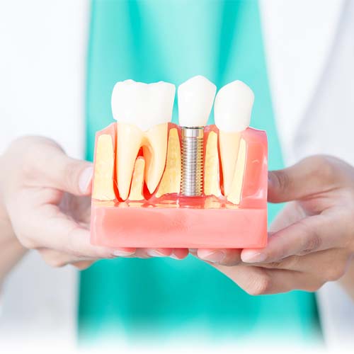 Услуга: имплантация