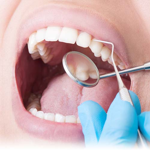 Услуга: лечение зубов